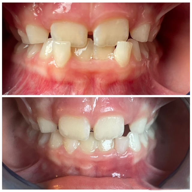 Vorher/Nachher Vergleich einer Dentosophie Behandlung bei einem 7 jährigen Mädchen